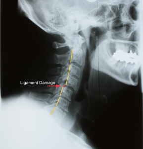 Ligament Damage in the Cervical Spine