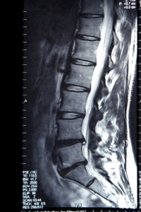 Disc Degeneration and Pettibon Chiropractic