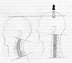 Loss of cervical stretches the spinal cord. Restore your cervical curve with Pettibon Chiropractic