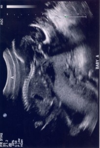 Fetal Ultra Sound at 18 Weeks Showing a Cervical Curve
