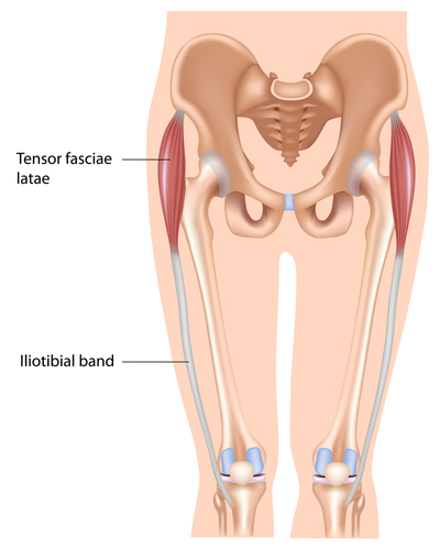 ITBand Syndrome can be helped with ESWT