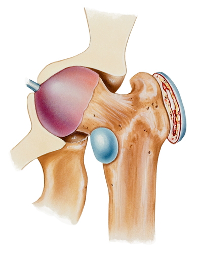Trochanteric Bursitis is helped with ESWT