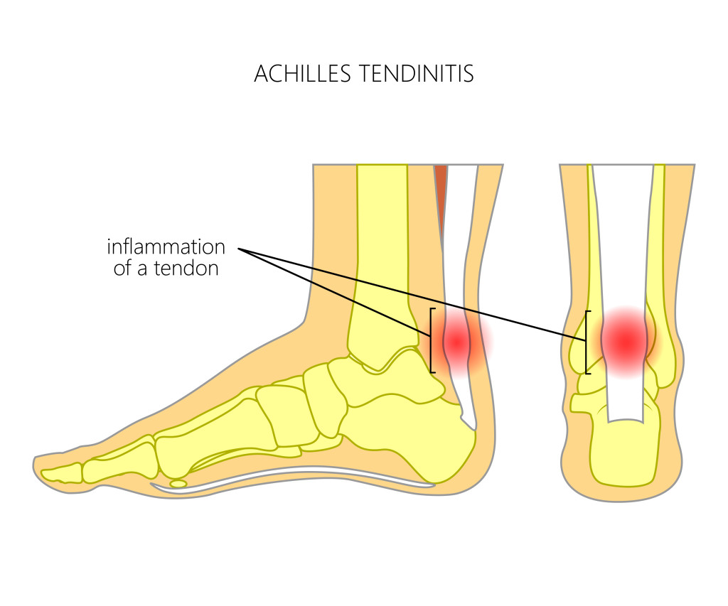 Achilles Tendonitis
