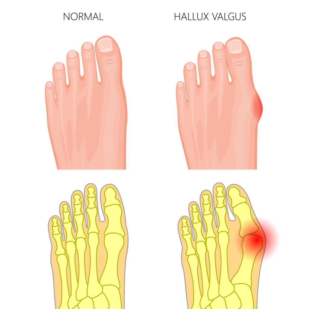 Bunions can be helped with ESWT
