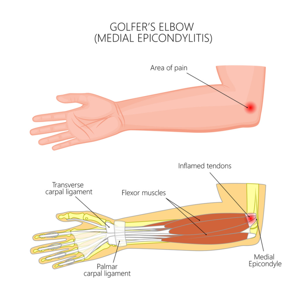 Golfer's elbow successfully treated with ESWt