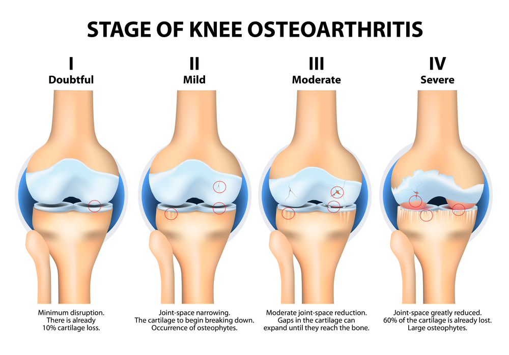 The pain of knee arthritic can be helped with ESWT