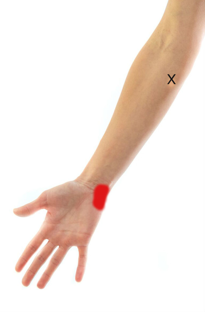 Trigger Point for Carpal Tunnel Syndrome helped with ESWT