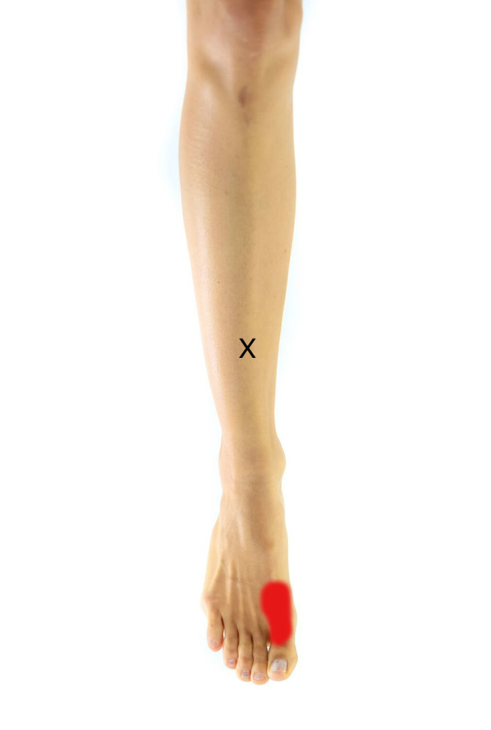 Extensor Hallicis Longus Trigger Point helped with ESWT