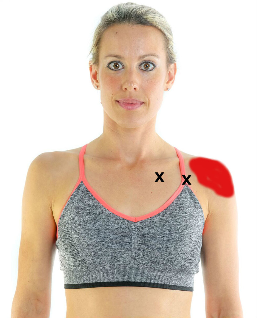 Pectoralis Major Muscle Trigger Point 