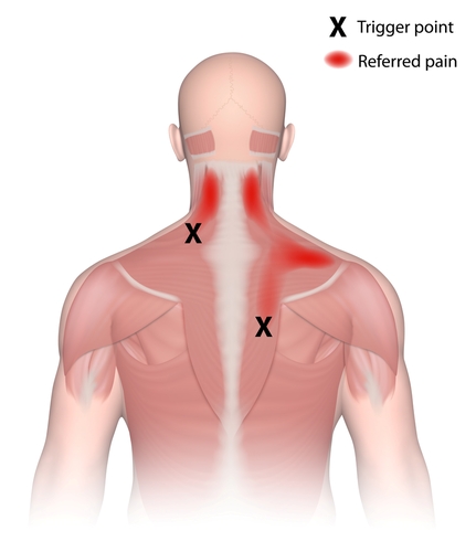 Myofascial Trigger Points Helped With Extracorporeal Shockwave